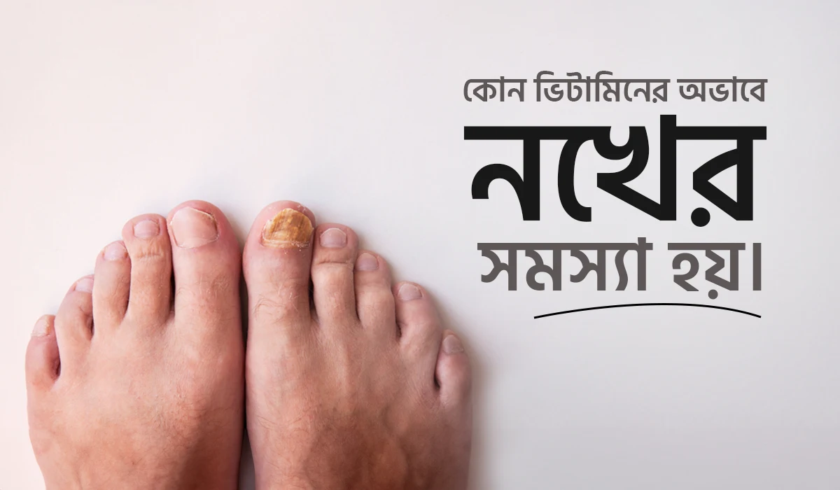 কোন ভিটামিনের অভাবে নখের সমস্যা হয়